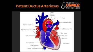 Patent Ductus Arteriosus PDA [upl. by Eruza117]